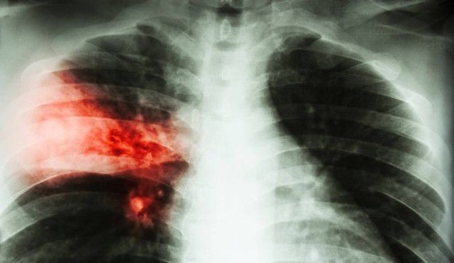 左氧氟沙星是常用抗菌药，可有效治疗4种感染，但这3类人群慎用