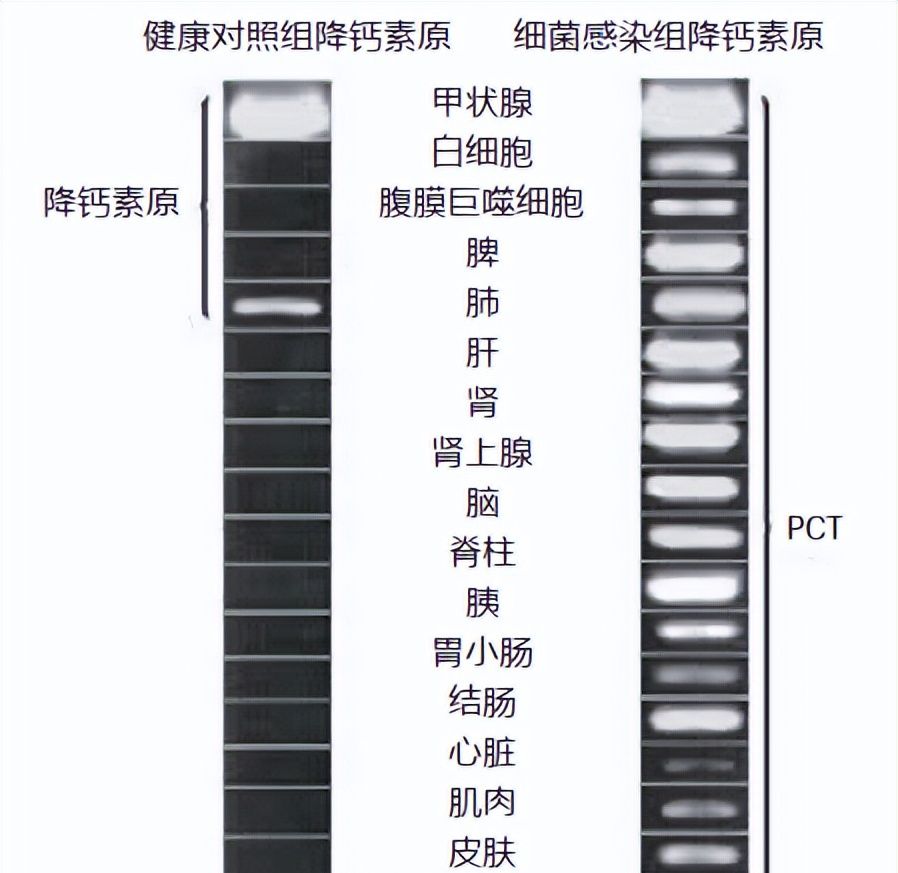 感染诊断利器：降钙素原（PCT）