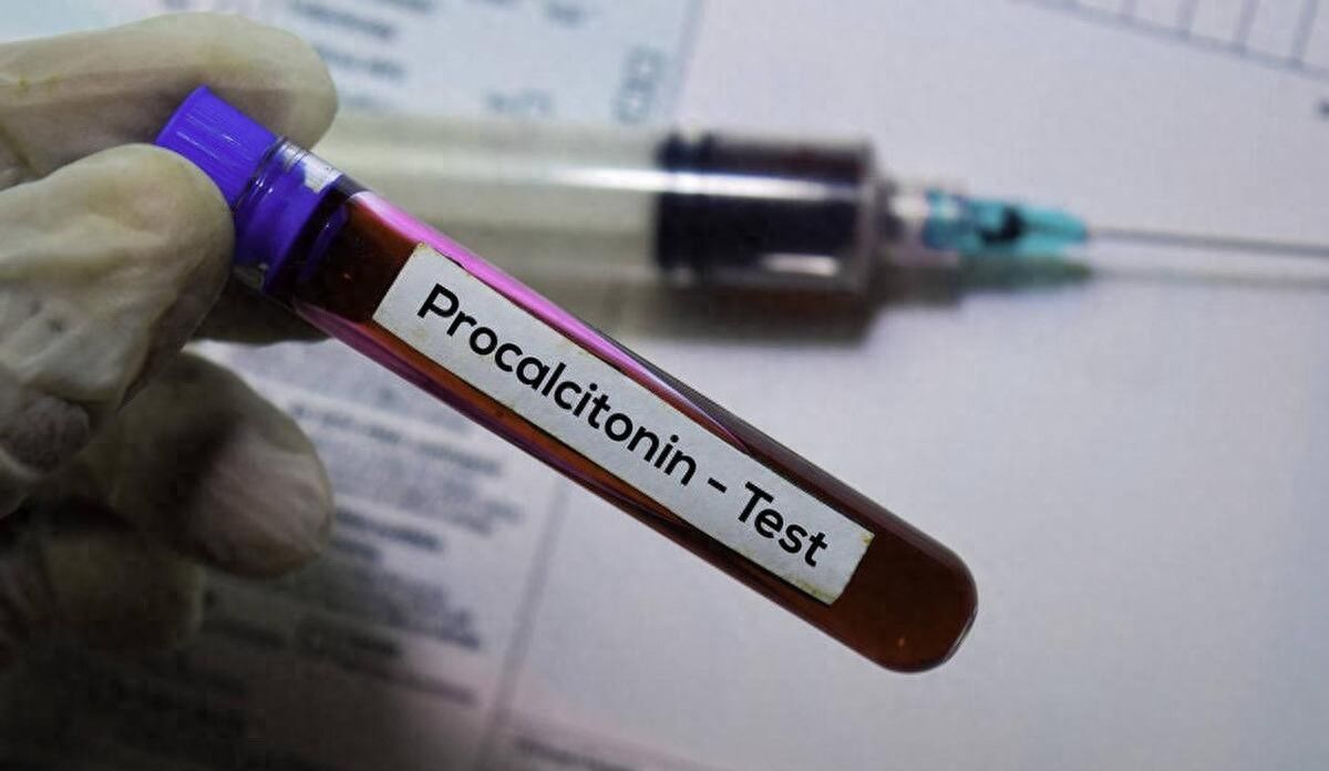 有关降钙素原（PCT）检验与临床应用问答（一） - 宋马