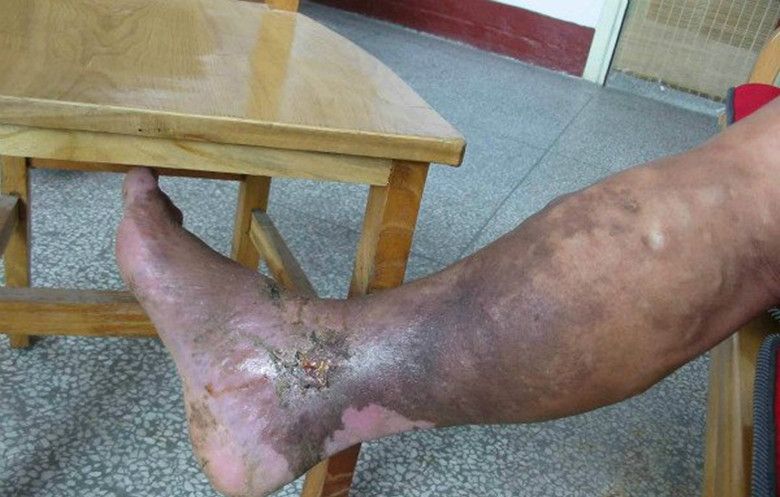 静脉曲张六级分类详解，可以帮你了解病情严重程度