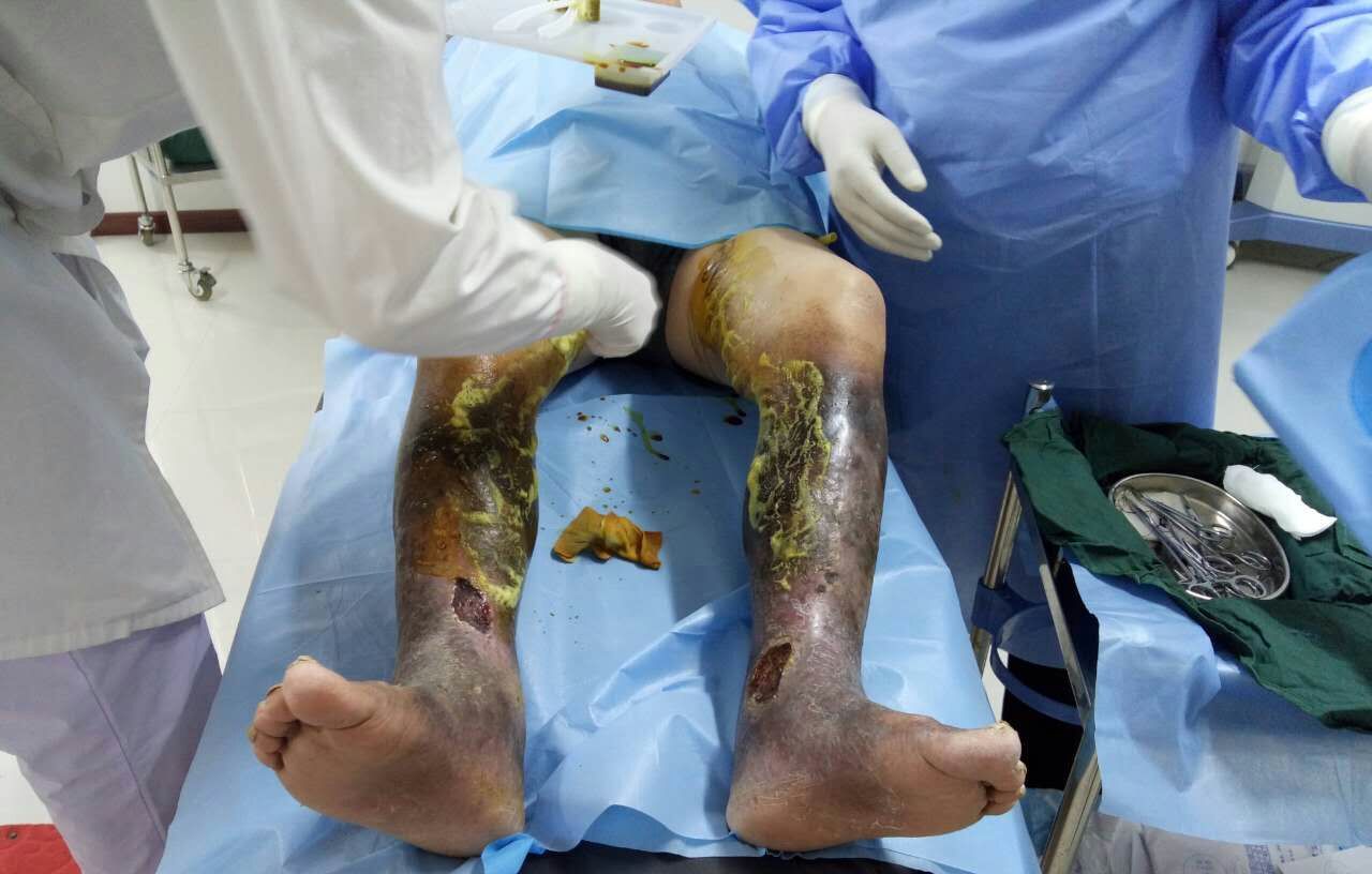 静脉曲张六级分类详解，可以帮你了解病情严重程度