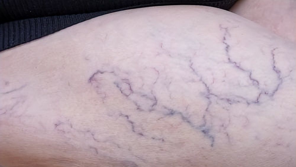 静脉曲张六级分类详解，可以帮你了解病情严重程度