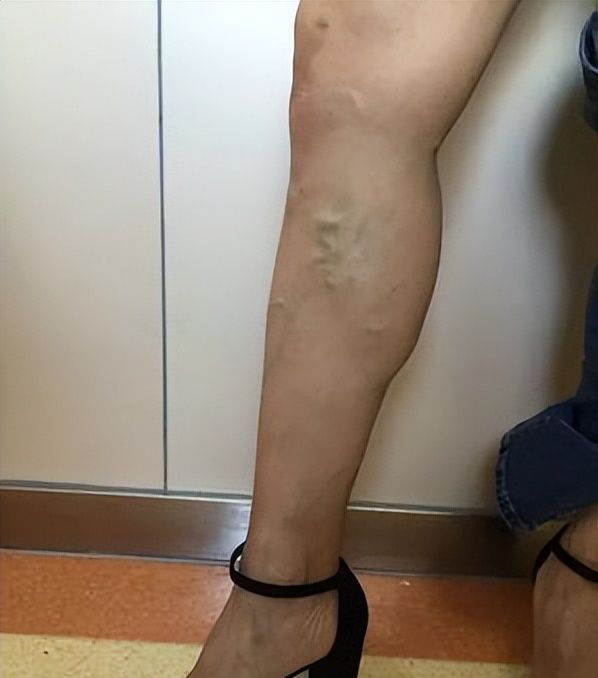 静脉曲张六级分类详解，可以帮你了解病情严重程度