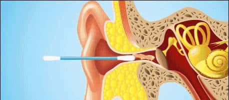给娃上医院掏耳屎花了5000块！平时应该怎么给娃掏耳屎？