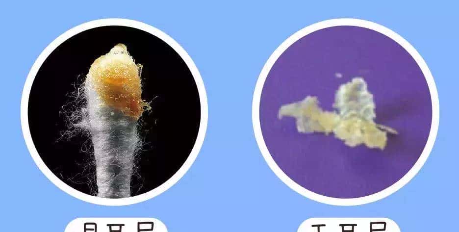 给娃上医院掏耳屎花了5000块！平时应该怎么给娃掏耳屎？