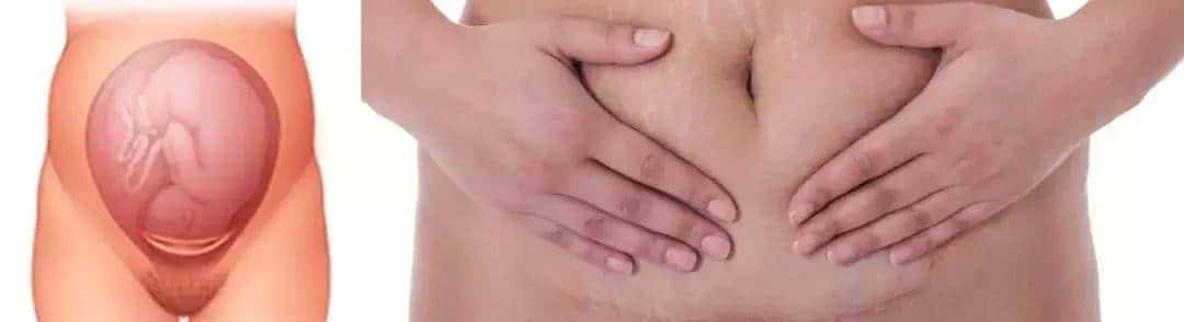 剖宫产还是顺产?这可能是个艰难的医学选择 - 宋马